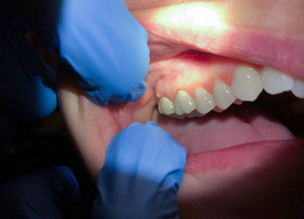 Best Knocked-Out Tooth (Avulsed Tooth) Treatment in Feasterville, PA